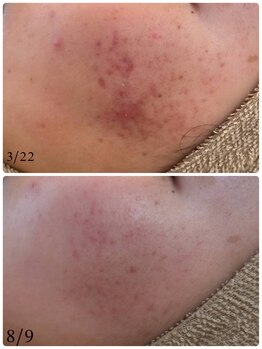 ユフラ(Juhla)/毛穴洗浄+韓国ハーブピーリング