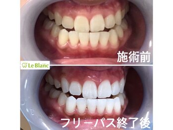 ルブラン 奈良店(Le Blanc)/ホワイトニングの食事制限