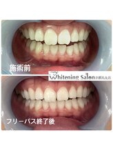 ホワイトニングサロン 京都烏丸店/ホワイトニング施術例