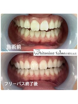 ホワイトニングサロン 京都烏丸店/ホワイトニング施術例