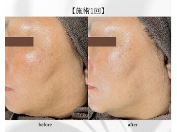 アン ビューティー(ann beauty)/施術1回【症例写真】