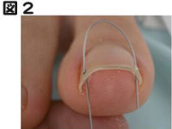 フットスタイル 八丁堀店(FOOT STYLE)/専門のプロによる巻爪矯正コース