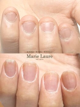 マリーロール 梅田店(Marie Laure)/自爪育成/深爪矯正/ネイルケア