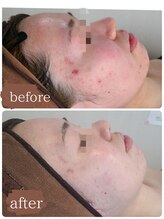 サロンド シェリー(Salon de Cherie)/剥けないハーブピーリング