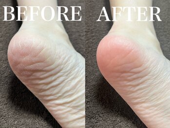 エルミオ エスパシオ ミロク(El mio espacio 369miroku)/カーボキシーパック～かかと編～