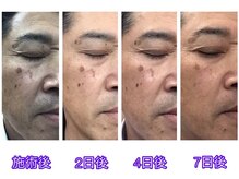 ラ スター 関内店(La star)/シミにアプローチ！シミケア