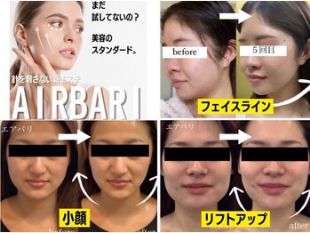 パルファンカルム 駅西本町店/小顔効果、リフトアップに期待!