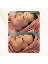 リリー(LILLY)/症例