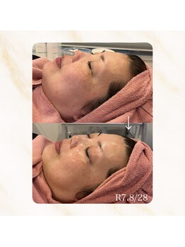 リリー(LILLY)/症例