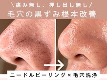 アロマ(AROMA)の雰囲気（開いた毛穴に、毛穴洗浄、毛穴レス、越谷/春日部/草加/大宮）