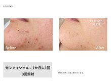 トータルクリア(TOTAL CLEAR)/光フェイシャル