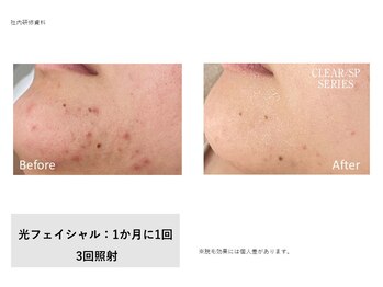 トータルクリア(TOTAL CLEAR)/光フェイシャル