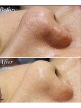 モモン シャルール/毛穴目立ちにHYALETUNEがお勧め