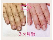 ブルームブルーム(BLOOMブルーム)/3ヶ月後には縦長爪！