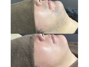 リリーブー 池袋(Lilyboo)/ヒゲ脱毛