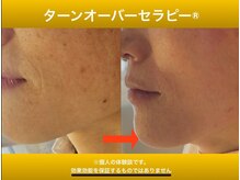 ターンオーバーセラピーの雰囲気（【天然松ヤニWAX】赤み、超乾燥肌の方にもオススメ◎）