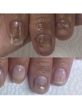 ウェルズユキ(well's yuki)/ジェルネイル/角質増殖