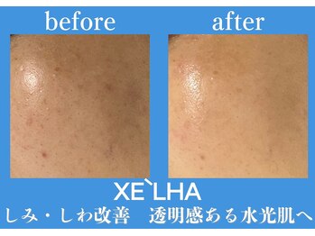 パールホワイトニングサロン 小田原店/セラピールでしみ/しわ改善