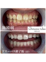 ホワイトニングサロン 京都烏丸店/ホワイトニング施術例