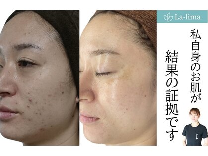 ラリマ(La-lima)の写真