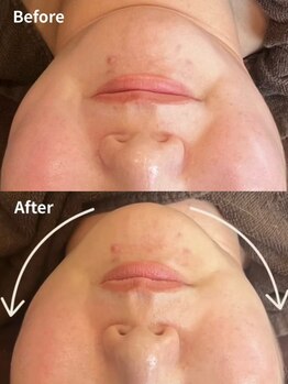 ウル 下北沢(Ulu)/お顔のアイロン-リフトマニア-