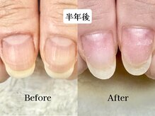 深爪矯正 爪悩み専門店 cocomo/(深爪/長さだし/フィルイン)