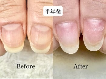 深爪矯正 爪悩み専門店 cocomo/(深爪/長さだし/フィルイン)