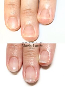 マリーロール 梅田店(Marie Laure)/自爪育成/深爪矯正/ネイルケア