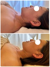 アンドモア(&more)/小顔症例