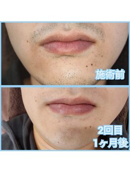 マイセルフ(myself)/ヒゲ脱毛施術例：20代
