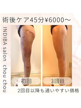 シュシュ/術後ケアもお任せください！
