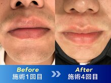 アリッサムフォーメン 岡山店(ALiSSUM for men)/1回目→4回目