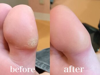 ドクターネイル爪革命 札幌本店/症例紹介25 たこケア