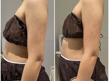 イデアルミー 大宮店(イデアルMe)/1回目Before　8回目After