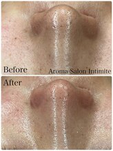 アンティミテ(Intimite)/毛穴洗浄1回の変化