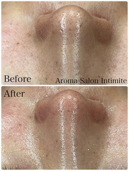 アンティミテ(Intimite)/毛穴洗浄1回の変化