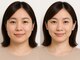 オリエンタルローザ 表参道(Oriental Rosa)の写真/最上位インディバER200【インディバフェイシャル75分】幹細胞増殖×速攻リフトUP!顔~頭皮をしっかり◎¥9800