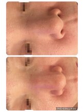 リボーン(be reborn)/毛穴の汚れスッキリ！