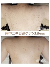 リブラン(Libran)/【美背中づくり】背中ケアコース