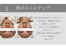 サラ 恵比寿店(SARA)/１フォトRF顔脱毛のメリット