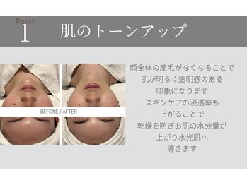 サラ 恵比寿店(SARA)/１フォトRF顔脱毛のメリット