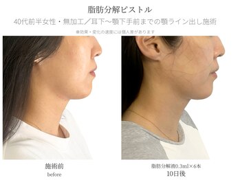 サボラミ(sabor A Mi)/小顔脂肪分解ピストル