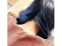 つむぎ養生堂マッサージ処の雰囲気（肩・首のこわばりに、鍼で丁寧にアプローチします）