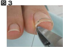 フットスタイル 八丁堀店(FOOT STYLE)/専門のプロによる巻爪矯正コース