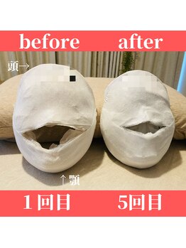 ロータス ビューティー(LOTUS Beauty)/石膏パックビフォーアフター