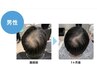 【ルミア式育毛促進メソッド】グロッティープロ×ヒト幹細胞培養液深部導入