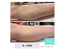 ティエル(TieLu)/足脱毛