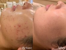 ビューティ ワンド ユズ(Beauty Wand YUZZ)/肌質改善ハーブピーリング　６回