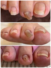 ルミエール(_Lumiere)/トラブルネイル