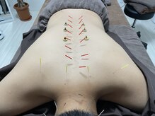 ハリトト鍼灸院/自律神経を整える鍼灸施術